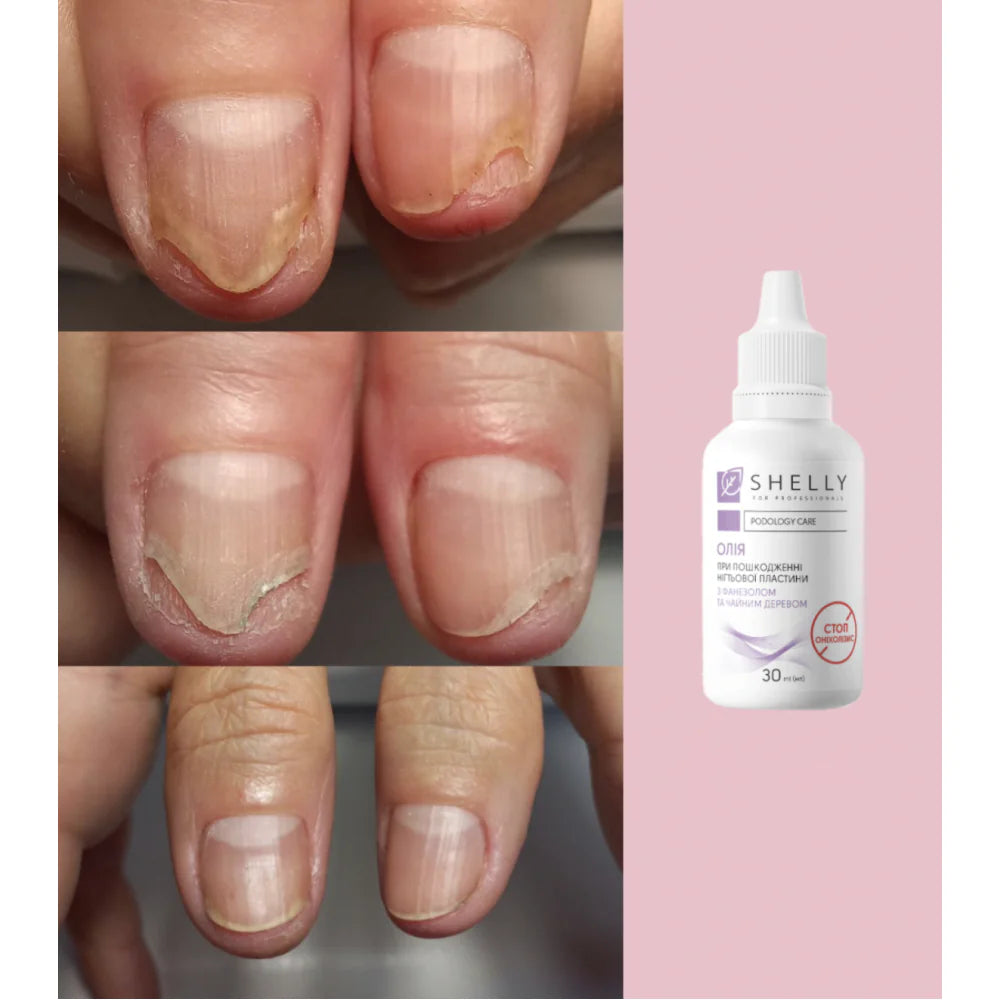 Oil for damage to the nail plate Stop Onycholichis Shelly 30 ML