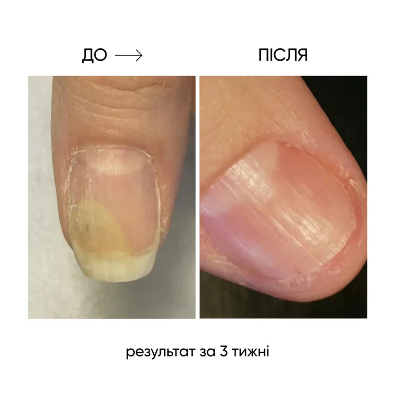 NAILSOFTHEDAY ONISTOP – regenerating oil against onycholysis 8 ml